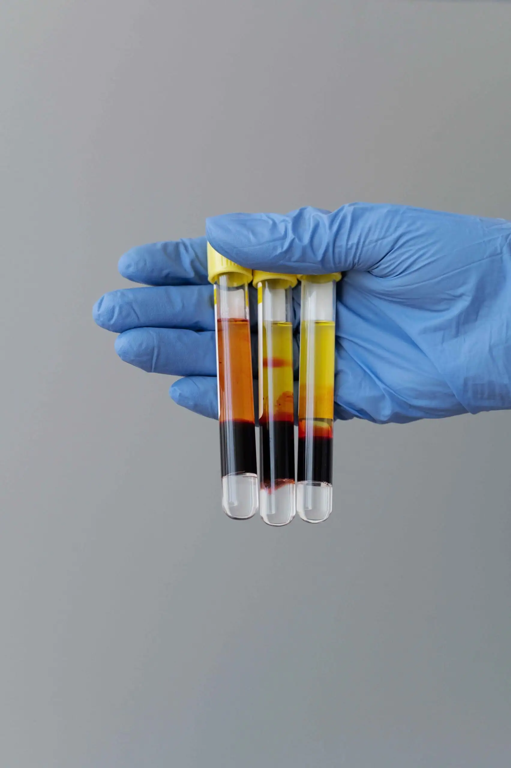 Αυξημένος αιματοκρίτης