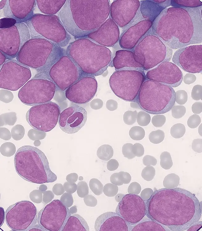 Οξεία λευχαιμία